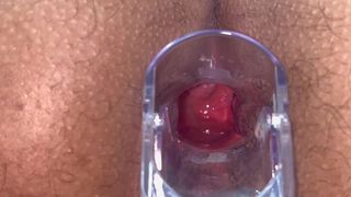 SPECULUM ANAL VISION