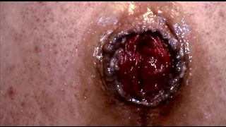 ANAL PROLAPSE & PUMPING