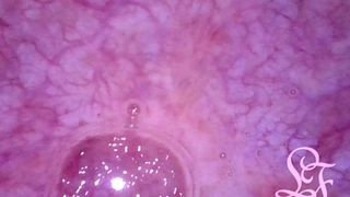 POV ENDOSCOPE CATHETER BLADDER INFLATION!