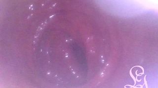 ANAL ENDOSCOPE ALL THE WAY IN MY TRANSVERSE COLON!